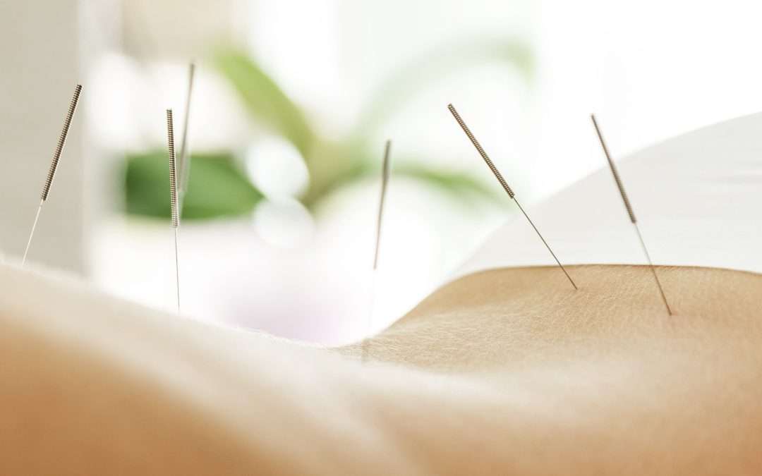 Acupuncture for Stress and Anxiety: Nurturing Tranquility in Modern Life