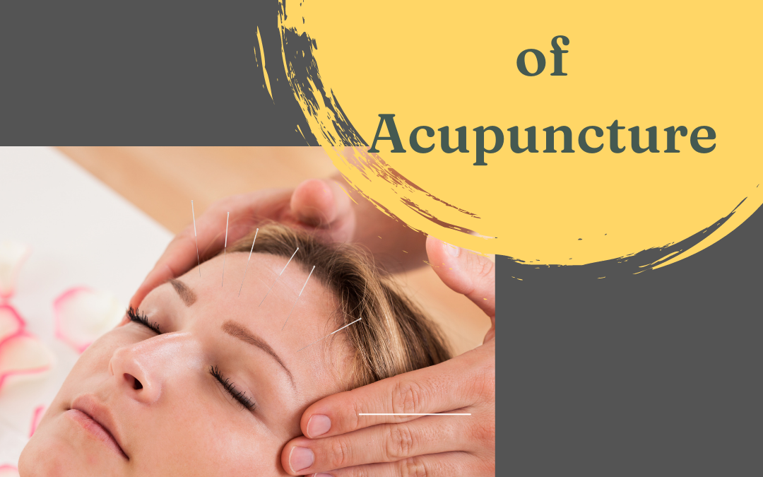 Mental Benefits of Acupuncture