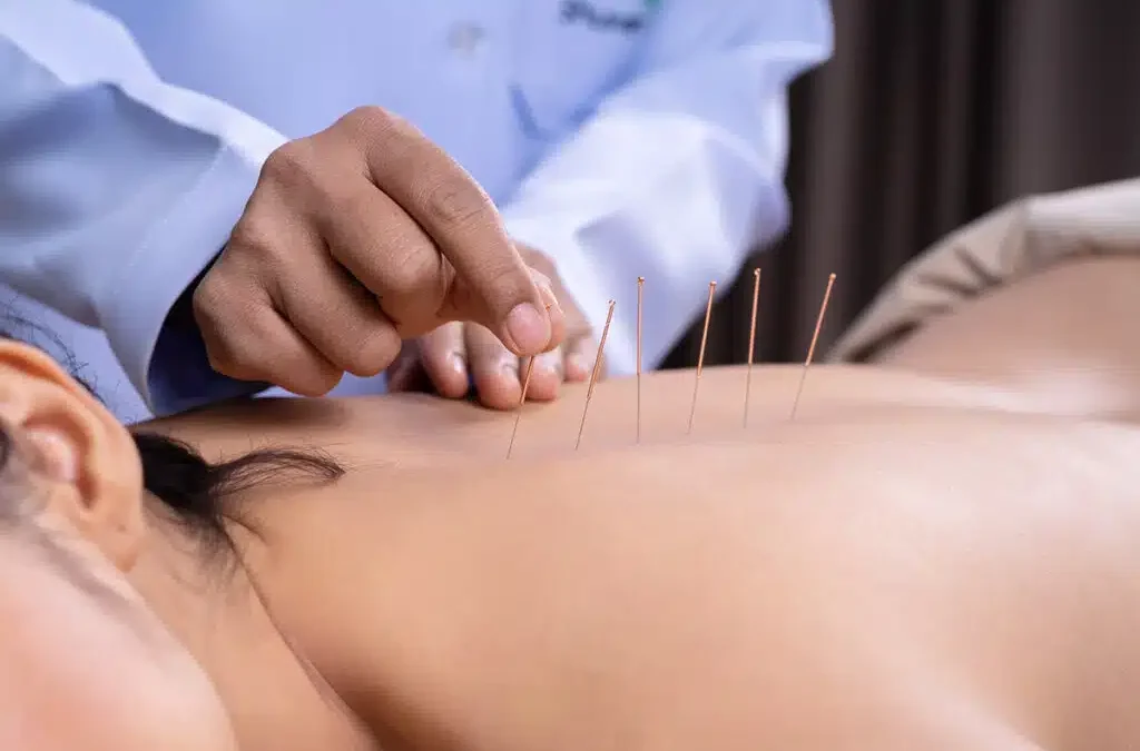 Acupuncture for Pain Management: A Holistic Approach to Wellness