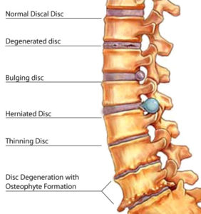 Low Back Pain | SF Custom Chiropractic
