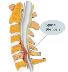 Spinal Stenosis | SF Custom Chiropractic